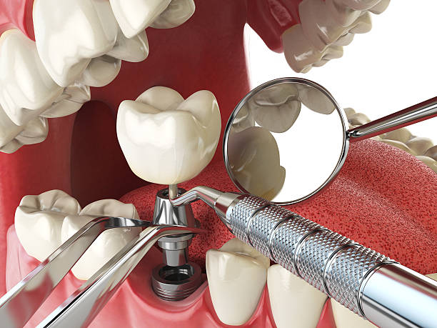 Best Emergency Dental Care for Broken or Chipped Teeth in Worthington, KY